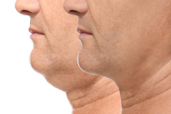 HIFU - Breakthrough in Anti - ageing 2 hifu results Herne Bay