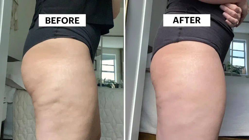Sculpting Your Bum: Can Toning Exercises Really Reduce Cellulite? 1 Do Toning Exercise Herne Bay Really Tackle Cellulite?