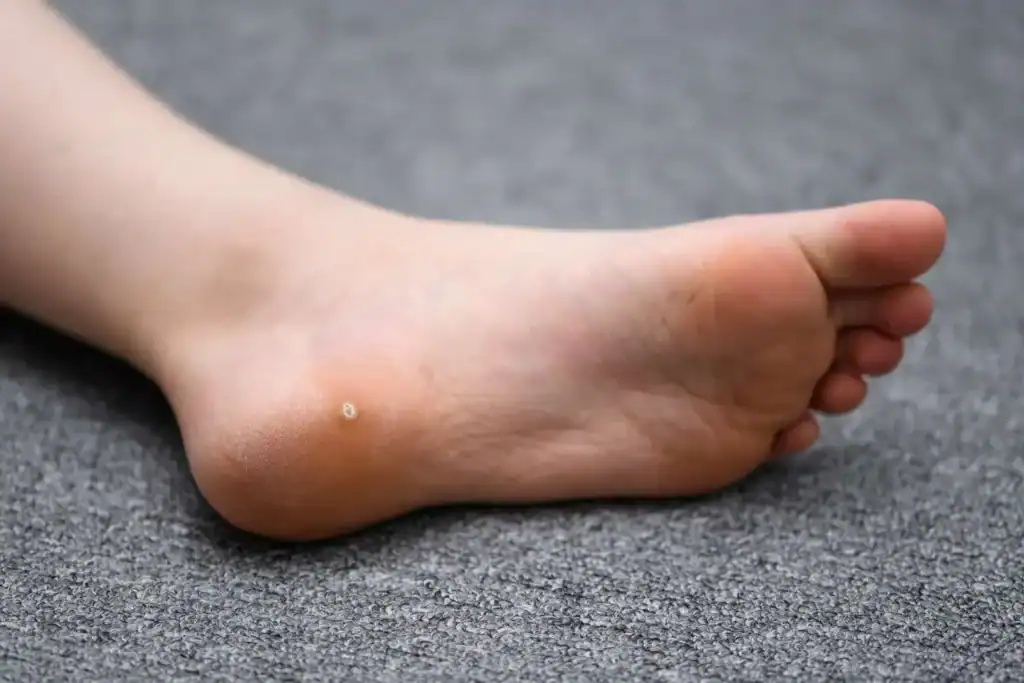 Cryotherapy For Warts And Also Verrucas 2 Image of verruca on the bottom of the foot that able to be treated with Cryotherapy Herne Bay