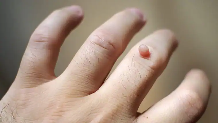 Image of blemish that Cryotherapy Herne Bay can remove with Lipo 360.