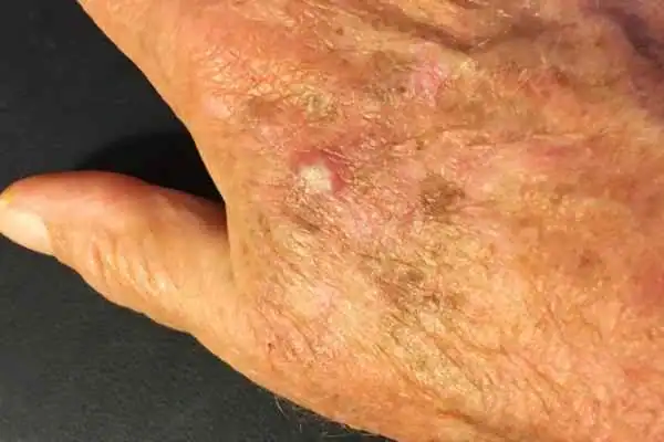 Image of Actinic keratoses Herne Bay on a person hand